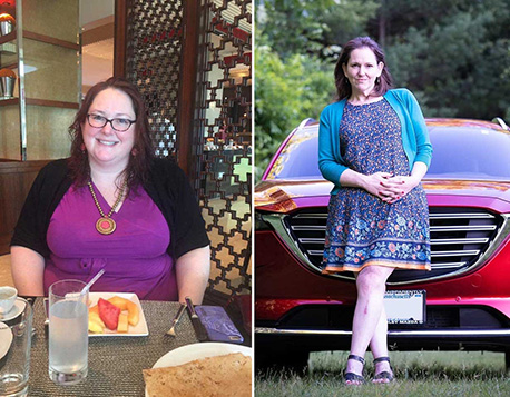patient julie before and after bariatric surgery